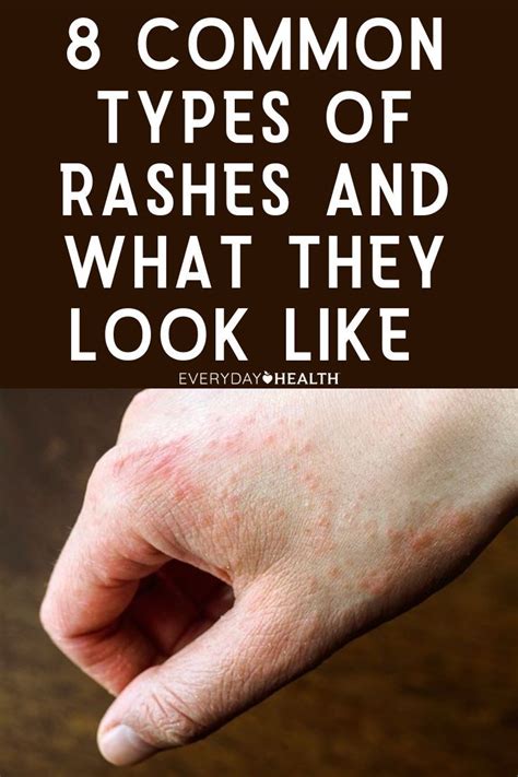 8 Common Types Of Rashes And What They Look Like Itchy Skin Rash Types Of Rashes Itching Skin