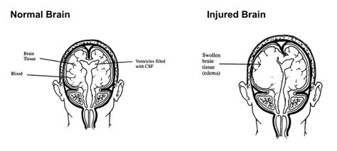 What Happens When The Brain Is Injured Abi Rehabilitation Services