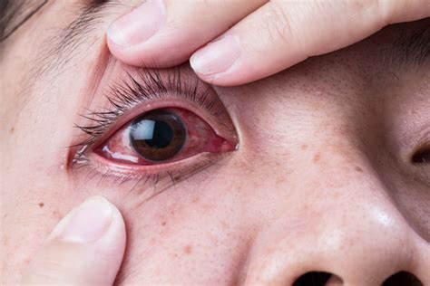 Symptoms Of Eye Infection