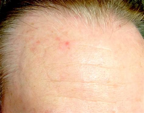 Bumps On Neck Hairline Pictures Photos