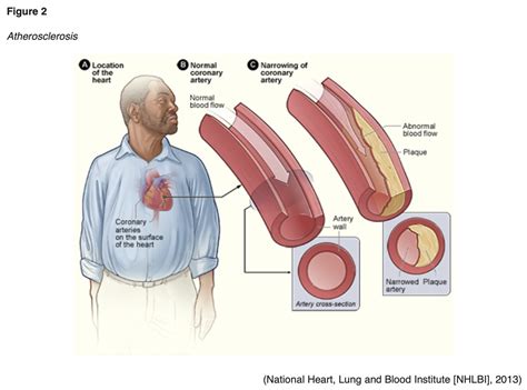 Cardiovascular Health And Prescribing For The Diabetic Patient For Rns