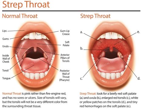 sore throat or strep throat how to tell the difference