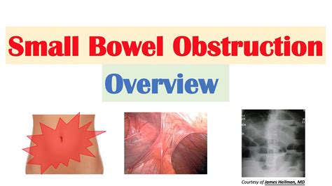 Small Bowel Obstruction Sbo Risk Factors Causes Signs And Symptoms