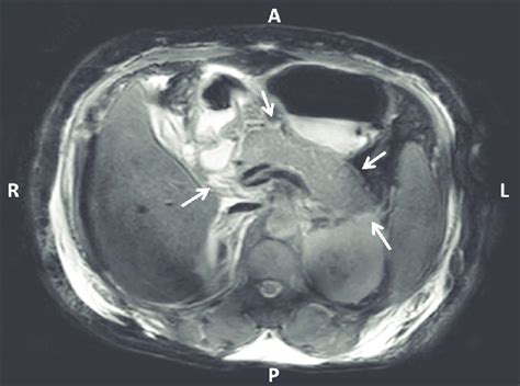 Axial T2 Weighted Mr Image Showing Enlarged Pancreas With Smooth