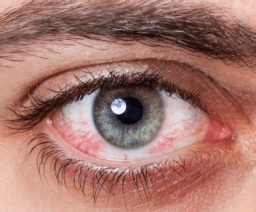 Red eyes (or red eye) is a condition where the white of the eye (the sclera) has become reddened or bloodshot. the appearance of red eye can vary widely. How to Get Rid of Red Eyes Fast, Bloodshot Eyes Causes ...