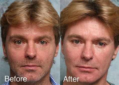Fixing Botched Lower Eyelid Surgery Steinsapir Kenneth