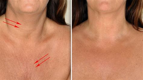 How To Get Rid Of Chest And Neck Wrinkles Naturally Youtube