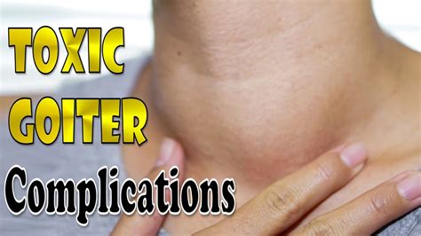 86 Toxic Goiter Complications Youtube