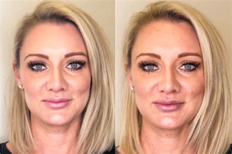 Dermal Fillers Before And After Pictures Case 31 Chico Yuba City