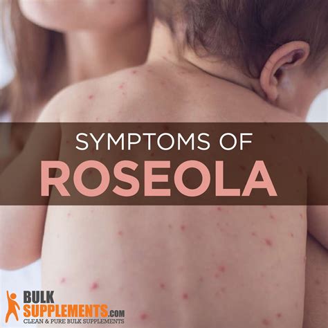 Roseola Symptoms Causes And Treatment By James