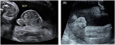 Discordant Fetal Sex On Nipt And Ultrasound Smet 2020 Prenatal Diagnosis Wiley Online