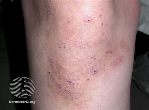 A Rash And An Upset Gut It Could Be Coeliac Disease — Dermatology