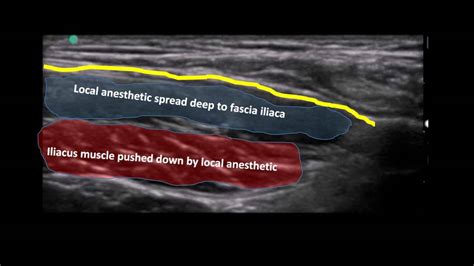 Ultrasound Guided Fascia Iliaca Nerve Block In A Paediatric Patient