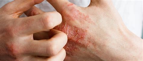 Dermatite Atopique Cause Quels Sont Les Différents Causes