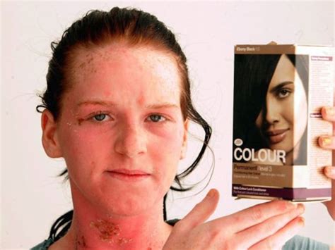 Hair Dye That Caused An Allergic Reaction 6 Pics