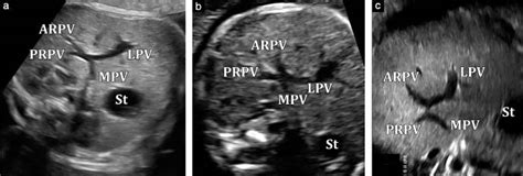 Gray Scale Ultrasound Images Showing Normal Anatomic Variants In The