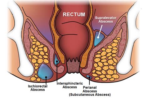 Anal Abscess Overview Dr Anastasios Christodoulou