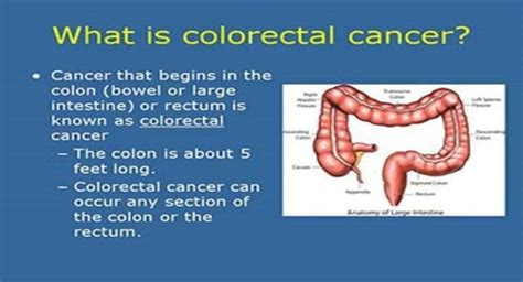Download Free Medical Overview Of Colorectal Cancer Powerpoint Presentation
