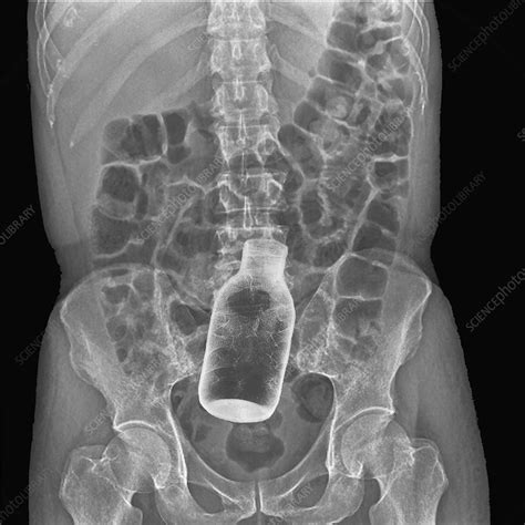 Bottle In Rectum X Ray Stock Image C Science Photo Library