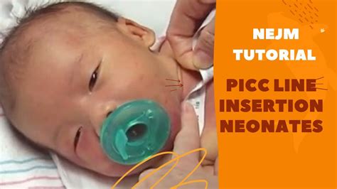 Picc Line Placement In Neonates Nejm Tutorial Youtube