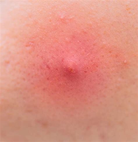 Armpit Pimple Types Causes And Treatments