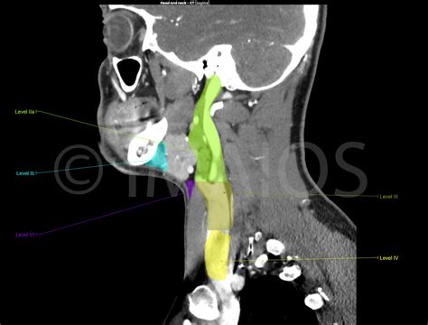 Normal Ct Scan Of Neck Lymph Nodes