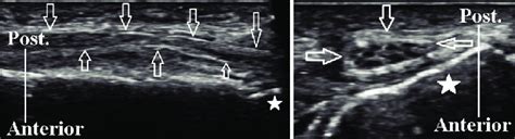 Normal Sonographic Appearance Of The Right Common Peroneal Nerve In An