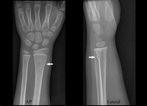 What Is A Buckle Fracture Of The Wrist