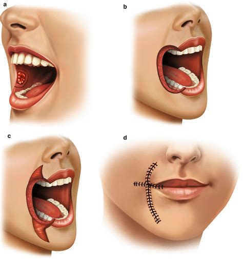 Reconstruction Of Complex Lip Defects Oncohema Key