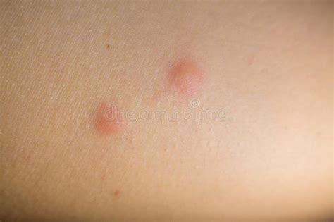 Insect Bites On Female Hand Stock Image Image Of Rash Disease 134822503