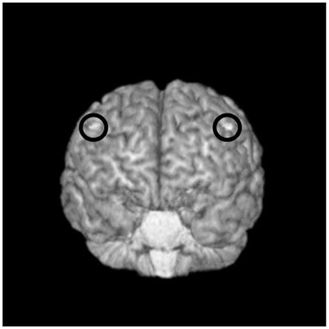 Targeting The Dorsolateral Prefrontal Cortex Dlpfc For Rtms