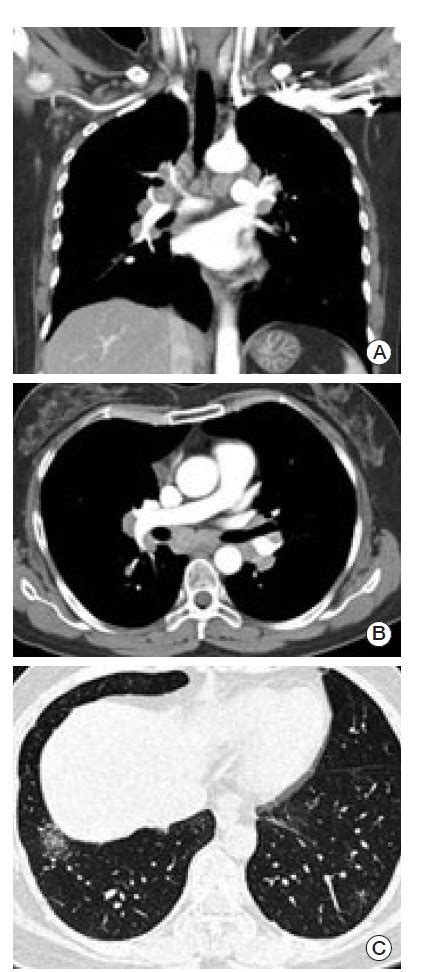 Chest Computed Tomography Scan A B Multiple Lymphadenopathies Were