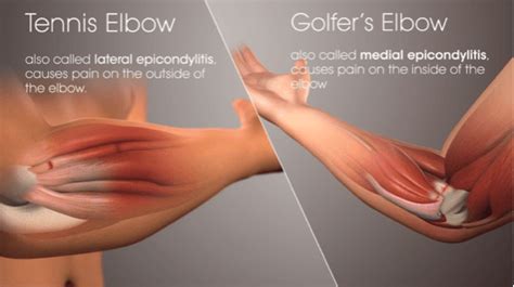 Golfers Elbow Medial Epicondylitis Rugpijn Oefeningen Oefeningen