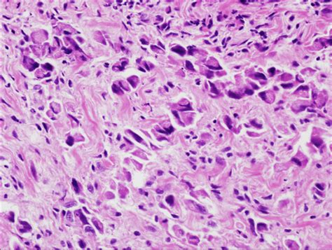 The Tumors Were Composed Of Cells With Hyperchromatic Eccentric Nuclei