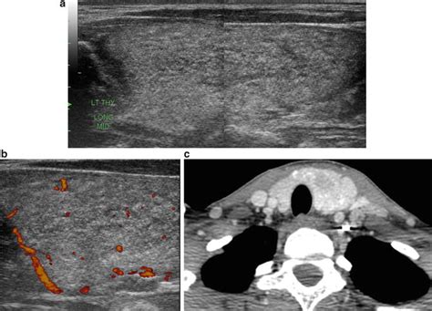 Pattern Recognition Of Benign And Malignant Thyroid Nodules Ultrasound