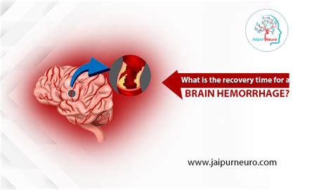 What Is The Recovery Time For A Brain Hemorrhage Jaipur Neuro