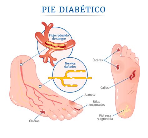 Pie Diabético síntomas causas y prevención Top Doctors