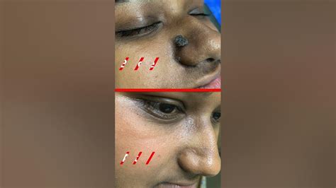 Instant Removal Of Wart On Nose By Mbbs Md Dermatologist Dr Uttam