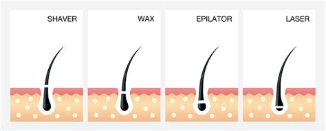 Diagram Of Laser Hair Removallaser Hair Removal Vector Vector