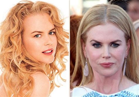 Nicole Kidman Plastic Surgery For Puffy Look