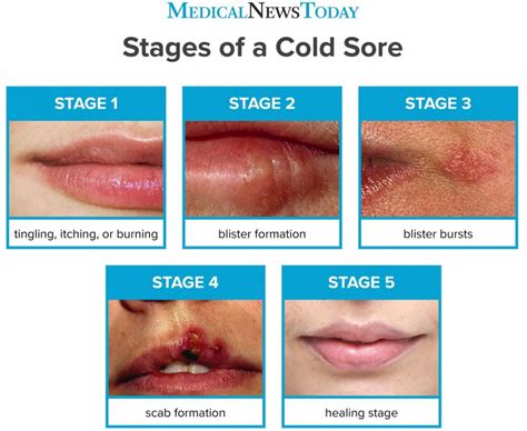 Over a few days, the sores break open, ooze, and form a crust before healing. Medical News Today: Stages of cold sore development: What to know - Central Alabama Wellness