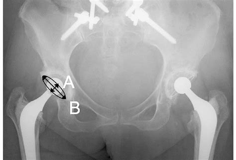 Radiological Method Of Measuring Acetabular Component Radiographic