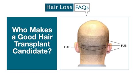 Who Makes A Good Hair Transplant Candidate Youtube