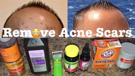 How to reduce acne scars you won't be able to remove acne scars completely while you can't remove acne scars completely, you can reduce acne scars and learn to embrace your skin. How to Remove Acne Scars, Dark Age Spots, or Uneven Skin ...