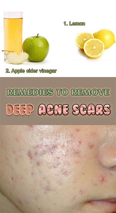 What Helps Heal Acne Scars Satura Blog