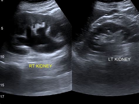 Prostate Cancer Ultrasound Image