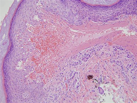 Angina Bullosa Hemorrhagicum Dermatopathology