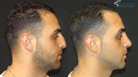 Male Rhinoplasty Before And After 20170518 1 Dr Shahidi