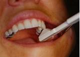 Craze Lines In Teeth Treatment Pictures