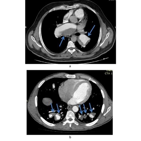 Axial Ct Pulmonary Angiography Of A 35 Years Male Patient With